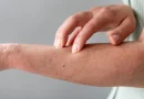 grzybica skóry